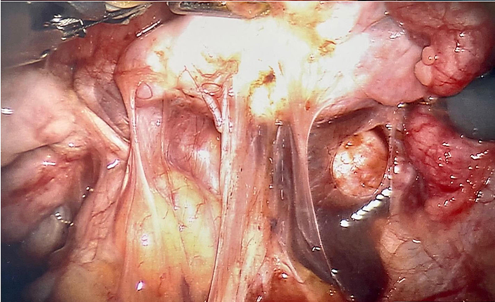 Pelvic-cavity-six-months-s/p-ovarian-endometrioma-cystectomy-showing-diffuse-fibrosis-and-adhesions.-