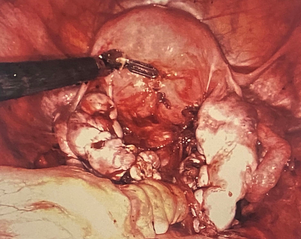 Bilateral-ovaries-and-uterus-immediately-s/p-ovarian-endometrioma-cystectomy-and-repair.-