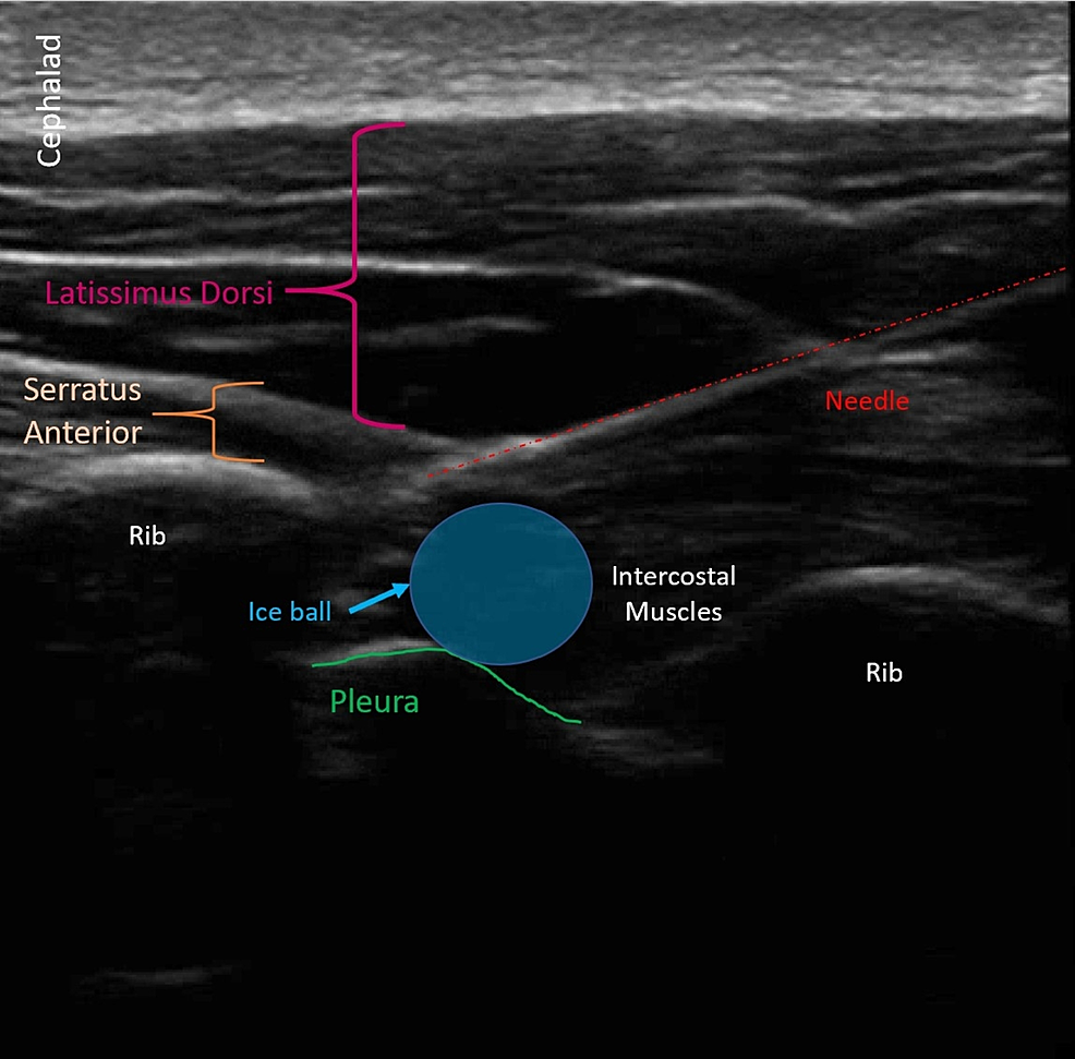 Ultrasound Guided Percutaneous Cryoneurolysis For Post Thoracotomy Pain Syndrome A Case Report