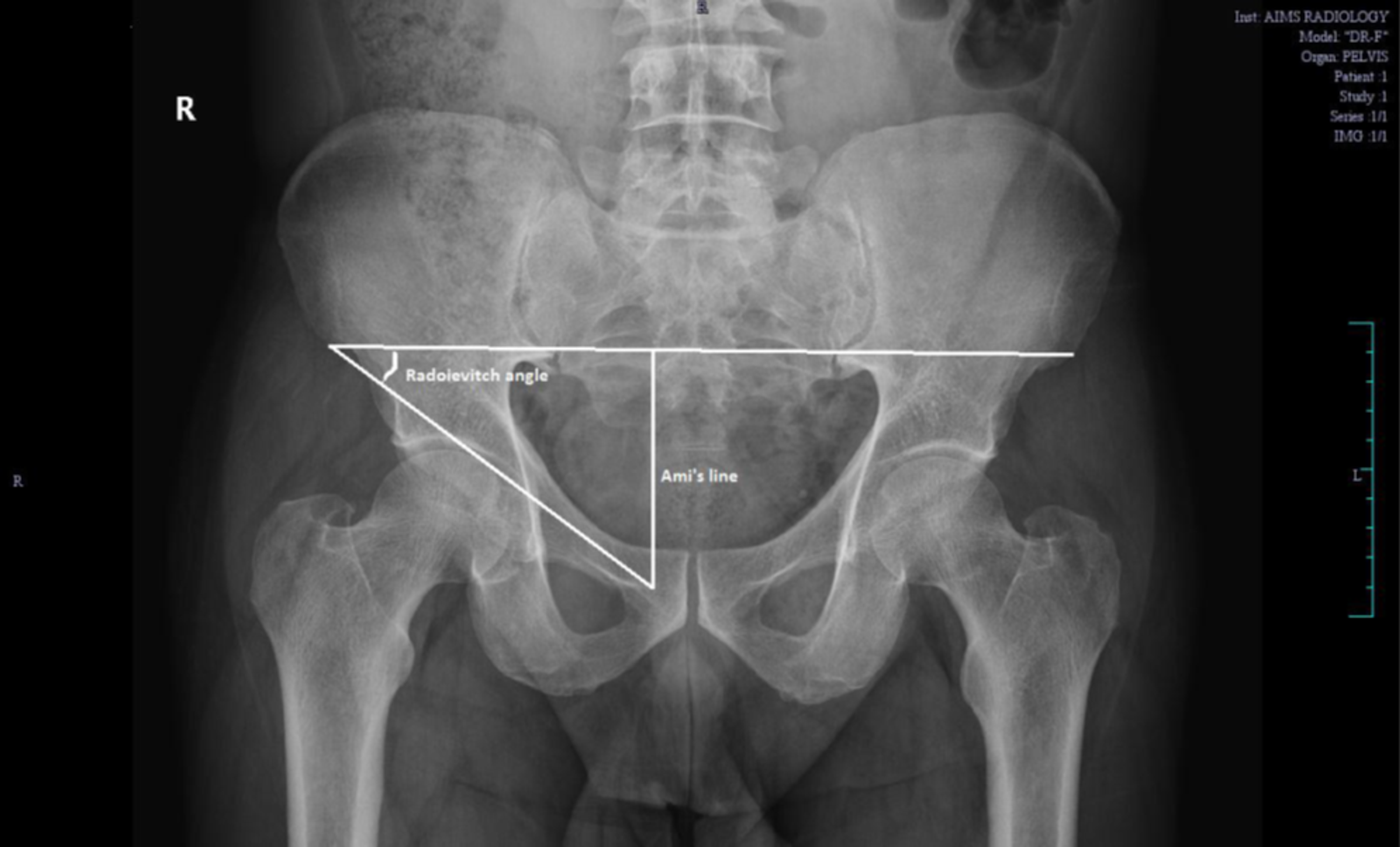 Cureus | Impact of Pelvic Bone Anatomy on Inguinal Hernia and the Role ...