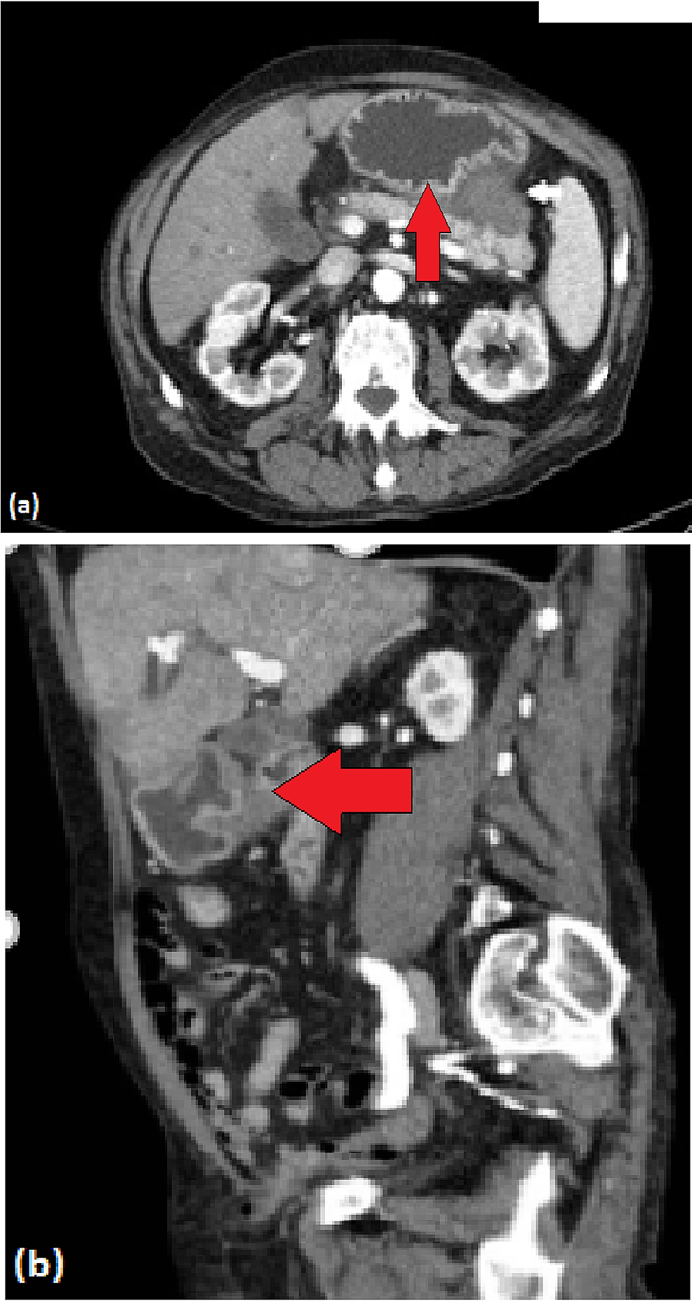 Cureus A Case Of Pancreatic Pseudocyst Complicated By Pseudoaneurysm