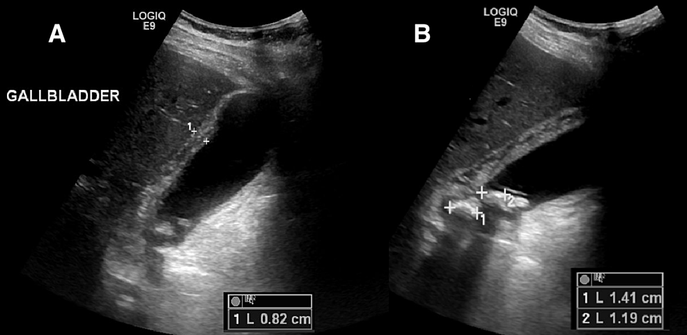 Ultrasound-gallbladder-showing-acute-calculous-cholecystitis