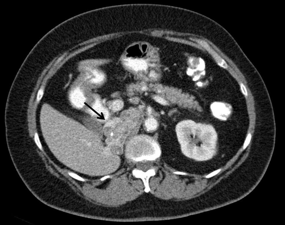 Cureus | Unusual Long Survival with a Giant Invasive Pheochromocytoma ...