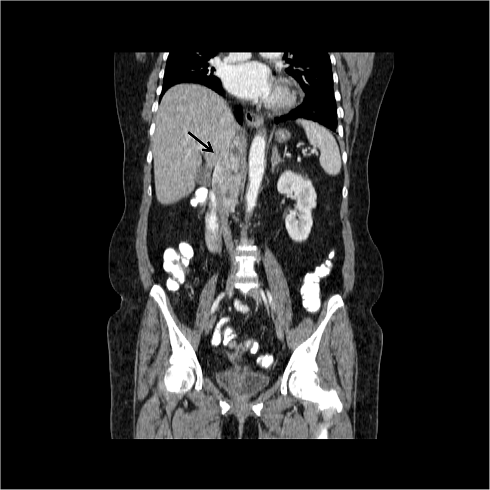 Unusual Long Survival With A Giant Invasive Pheochromocytoma Of An Incompatible Patient Cureus 0541