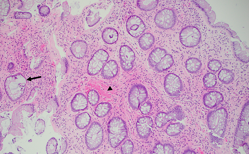 Cureus Solitary Rectal Ulcer Syndrome Mimicking Perianal Crohns Disease 2897