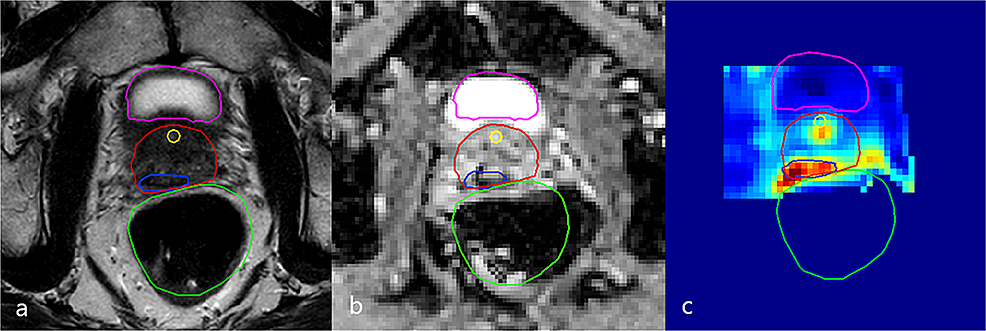 Cureus Re Salvage Mri Guided Focal High Dose Rate Brachytherapy For Locally Recurrent Prostate 8936