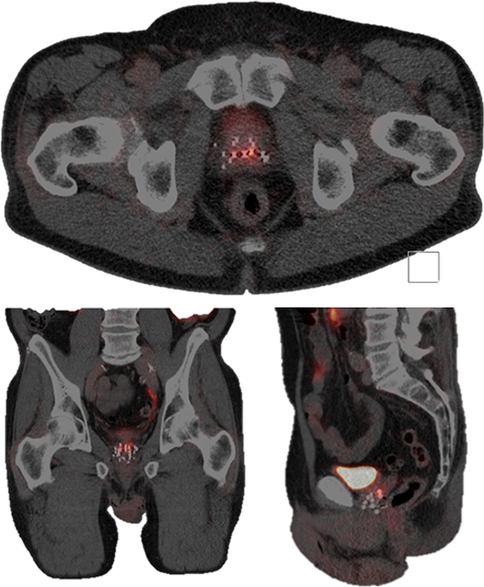 Cureus Re Salvage Mri Guided Focal High Dose Rate Brachytherapy For Locally Recurrent Prostate 2032