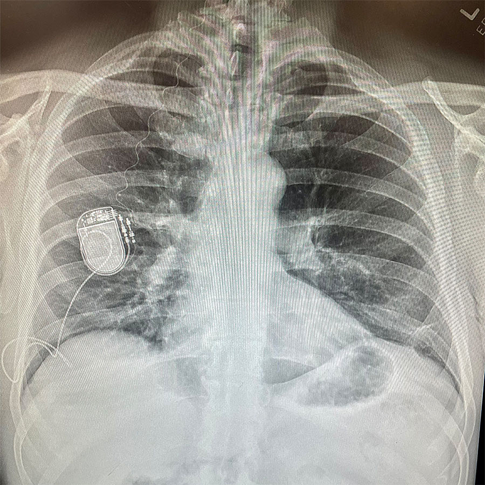 Chest-radiograph-showing-the-HGNS-system.