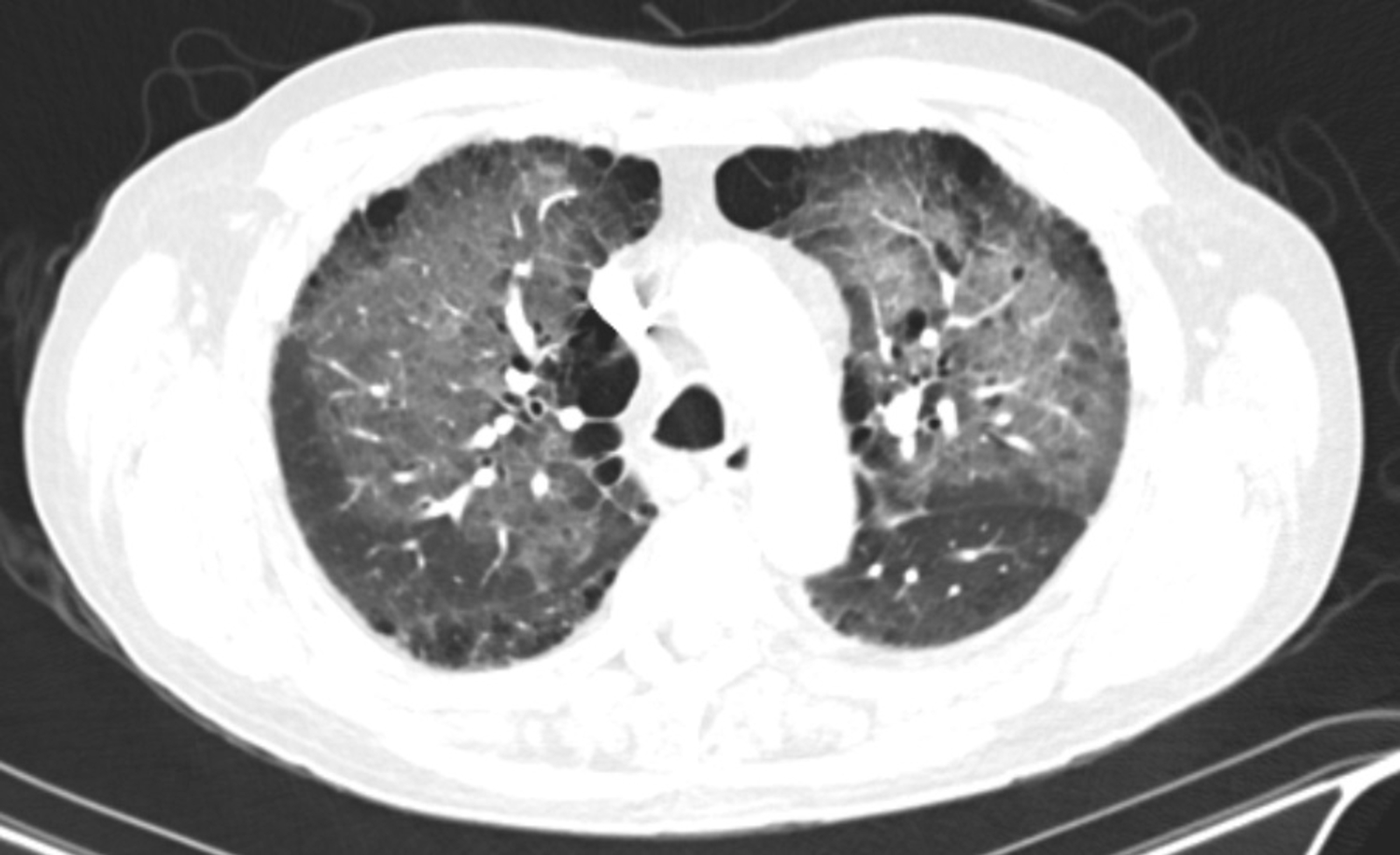 Cureus | Organizing Pneumonia Secondary to Pulmonary Actinomycosis: A ...