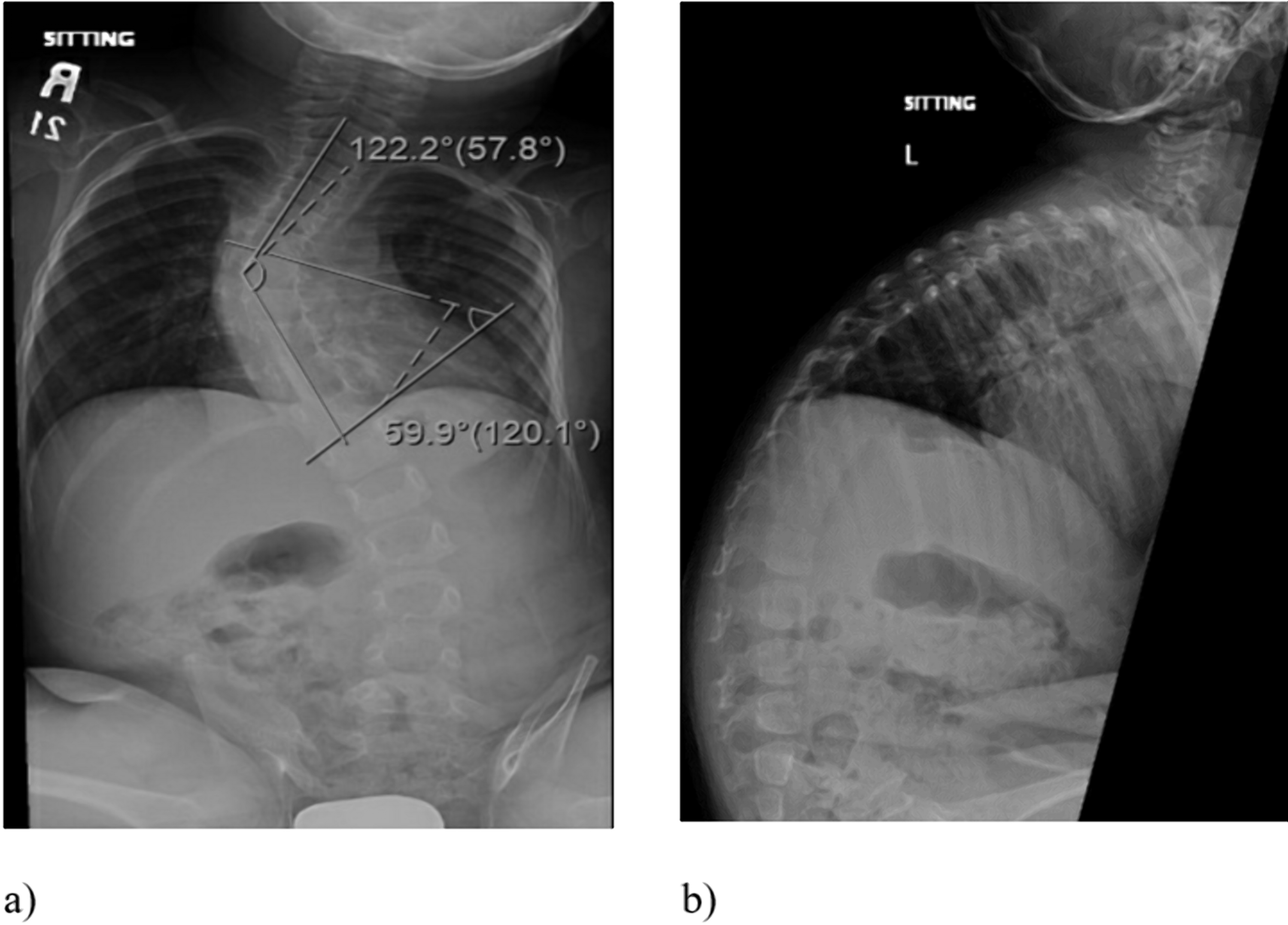 Cureus of Vertical Expandable Prosthetic Titanium Rib (VEPTR