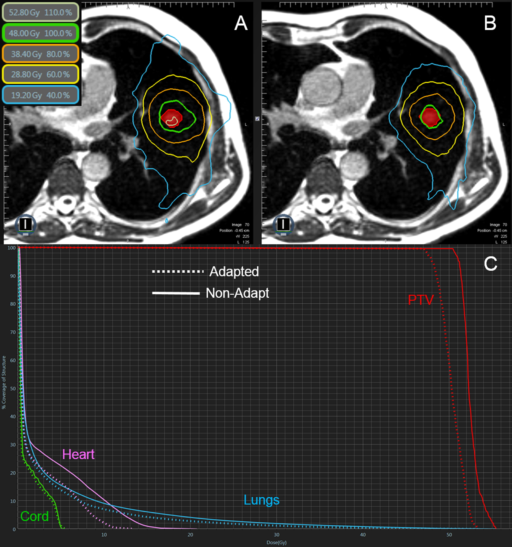 Cureus | Feasibility Of Adaptive MR-guided Stereotactic Body ...