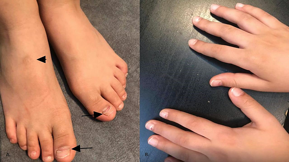 (A)-Arrows-point-to-Beau's-lines-over-the-big-toes-and-onychomadesis-over-the-toenails-of-both-feet;-arrowheads-demarcate-post-inflammatory-hyperpigmentation-following-the-resolution-of-HFMD-papulovesicular-eruptions;-(B)-On-the-thumb,-index,-and-middle-finger-of-both-hands,-there-are-nail-changes,-onychomadesis,-and-Beau's-lines-secondary-to-HFMD