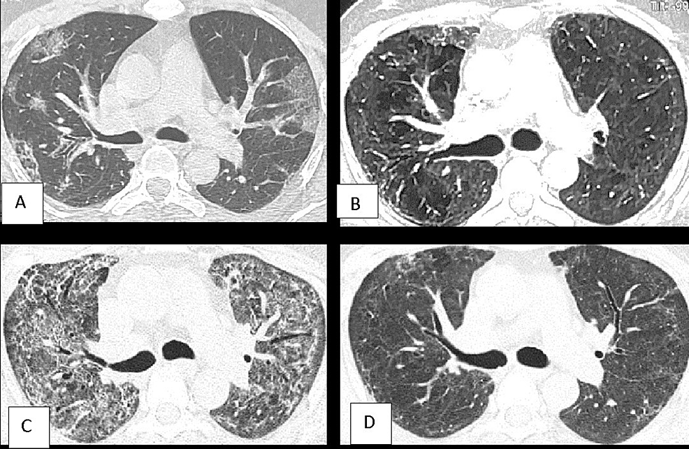 A-40-year-old-male-with-waxing-waning-lung-CT-opacities
