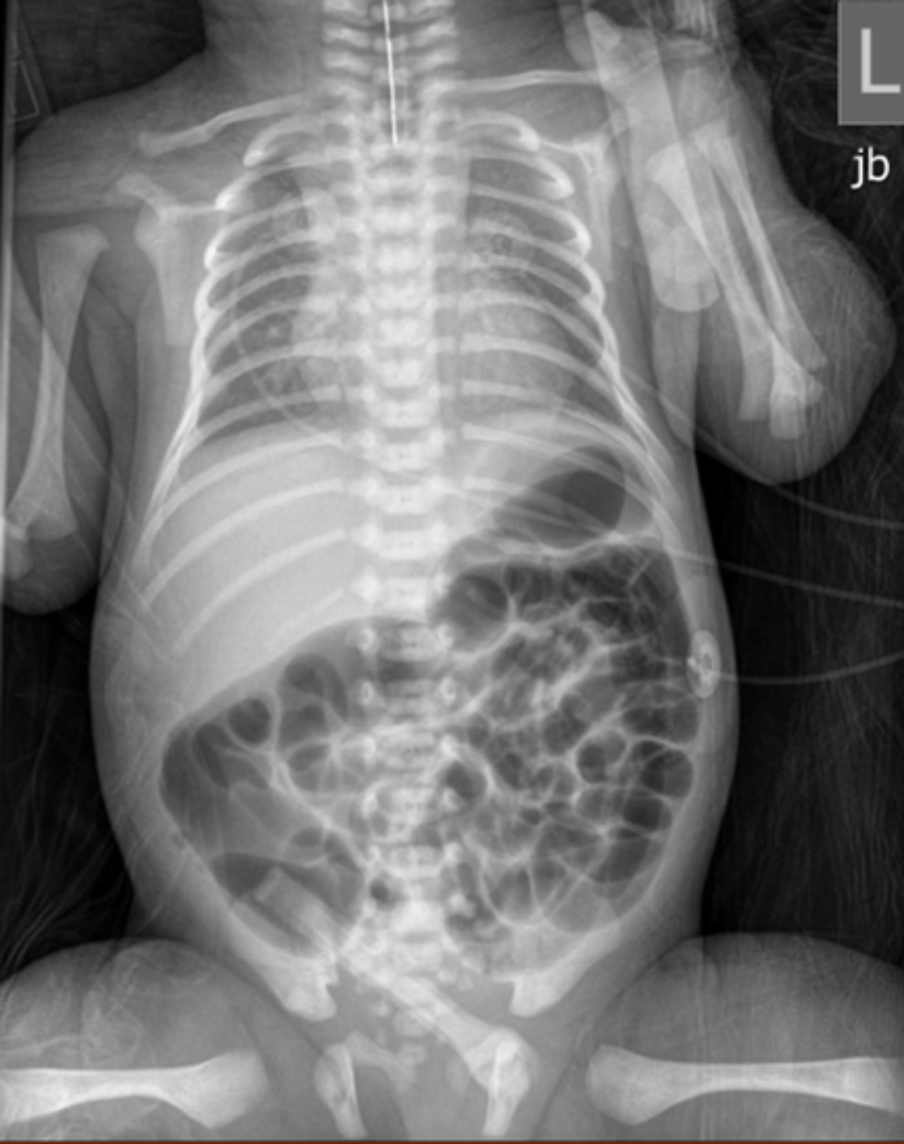 Cureus | A Network of Anomalies Prompting VACTERL Workup in a Trisomy ...