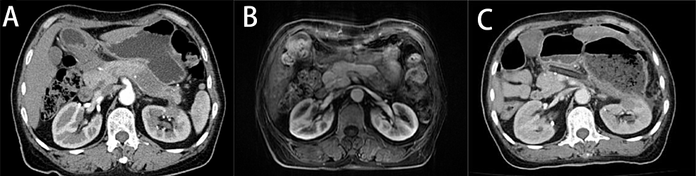 Abdominal-computed-tomography-scan-(A)-and-Magnetic-resonance-imaging-(B)-demonstrate-a-tumor-in-the-tail-of-pancreas.-Abdominal-computed-tomography-(C)-showed-intra-abdominal-free-gas,-peri-gastric-exudation-and-possible-discontinuity-of-gastric-wall.