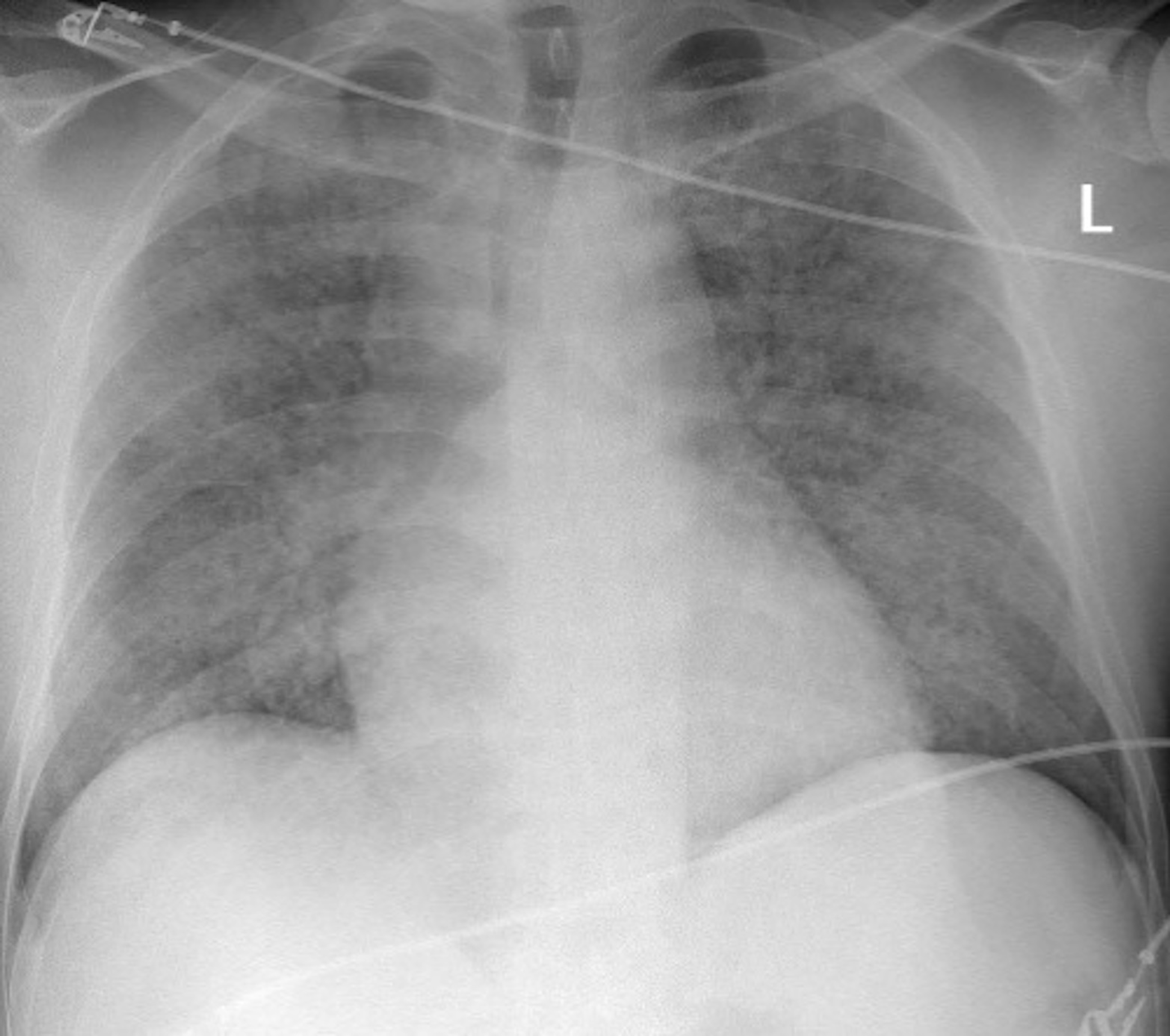 Cureus Diffuse Alveolar Hemorrhage An Unexpected Effect After Taking