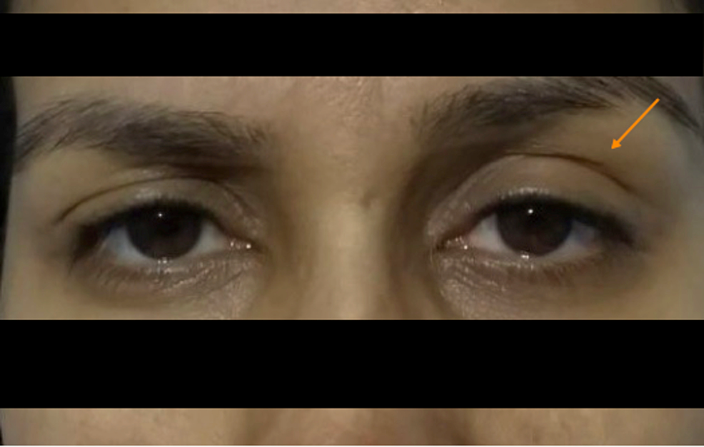 Ptosis-of-left-eyelid-and-miosis-of-the-ipsilateral-eye.