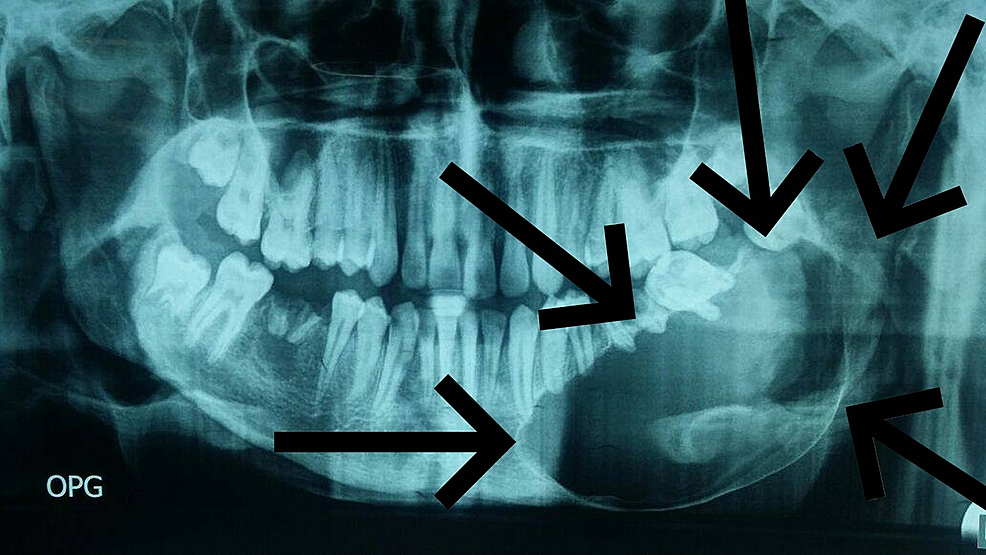 Orthopantomogram-showing-large-well-defined-radiolucency-on-the-left-side-of-the-mandible