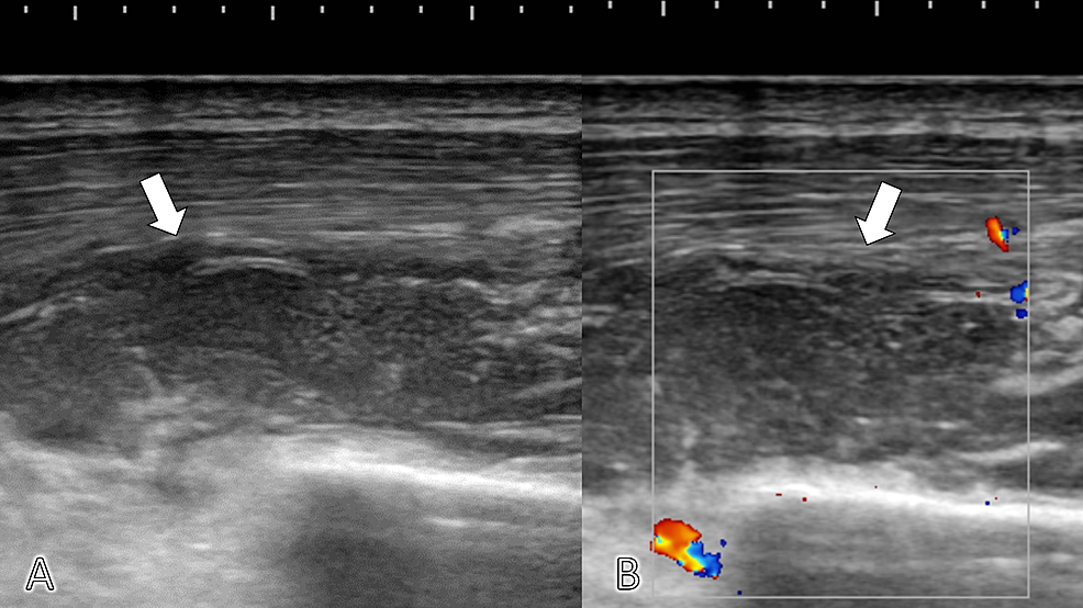 Soft-tissue-ultrasonography