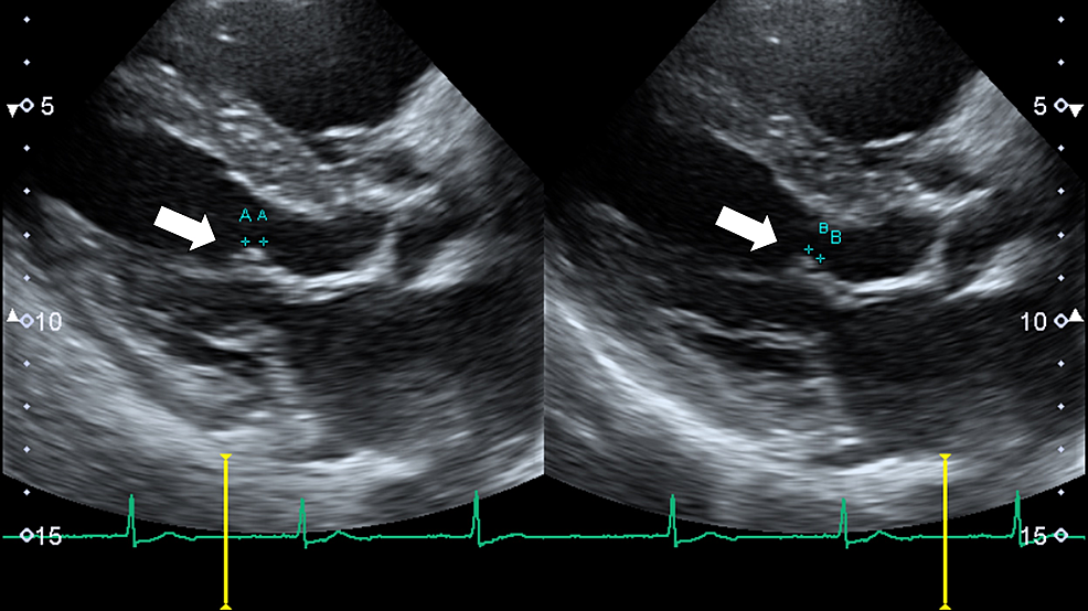 Transthoracic-echocardiography-on-the-fourth-day-of-hospitalization-revealing-a-4–5-mm-vegetation-on-the-anterior-mitral-leaflet-(white-arrows-pointing-to-the-vegetation-shown-by-+-+)