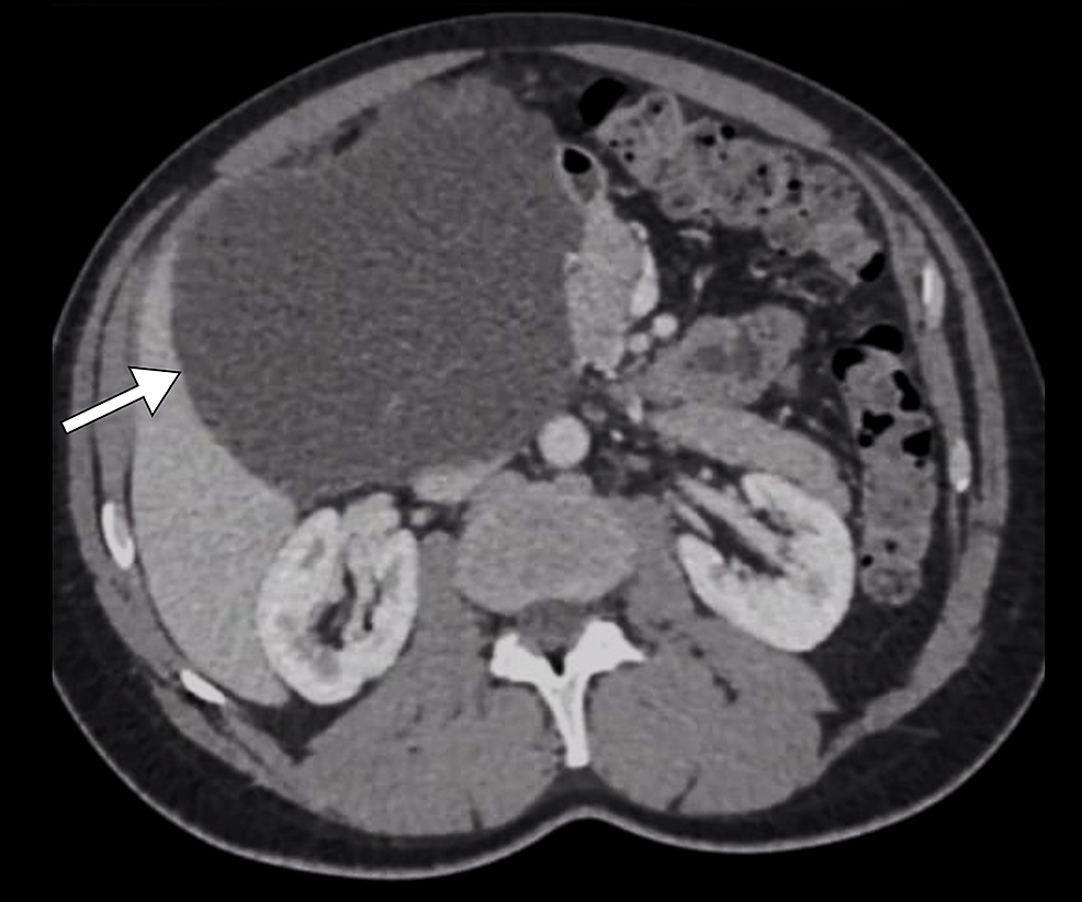Axial-CT-image-demonstrates-a-large-cystic-lesion-(arrow)-likely-arising-from-the-pancreatic-head.