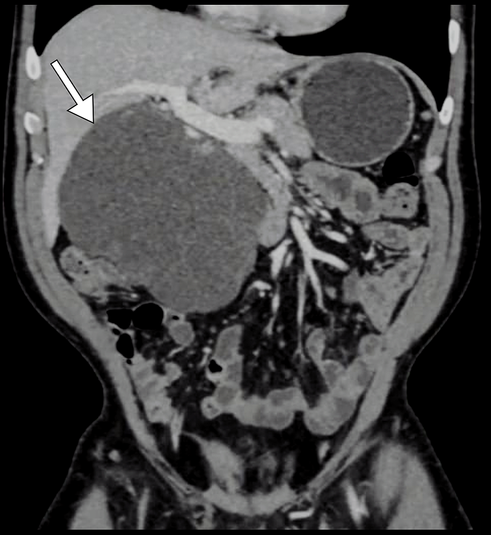 Coronal-CT-image-shows-a-well-defined-cystic-lesion-(arrow)-with-its-pressure-effect.