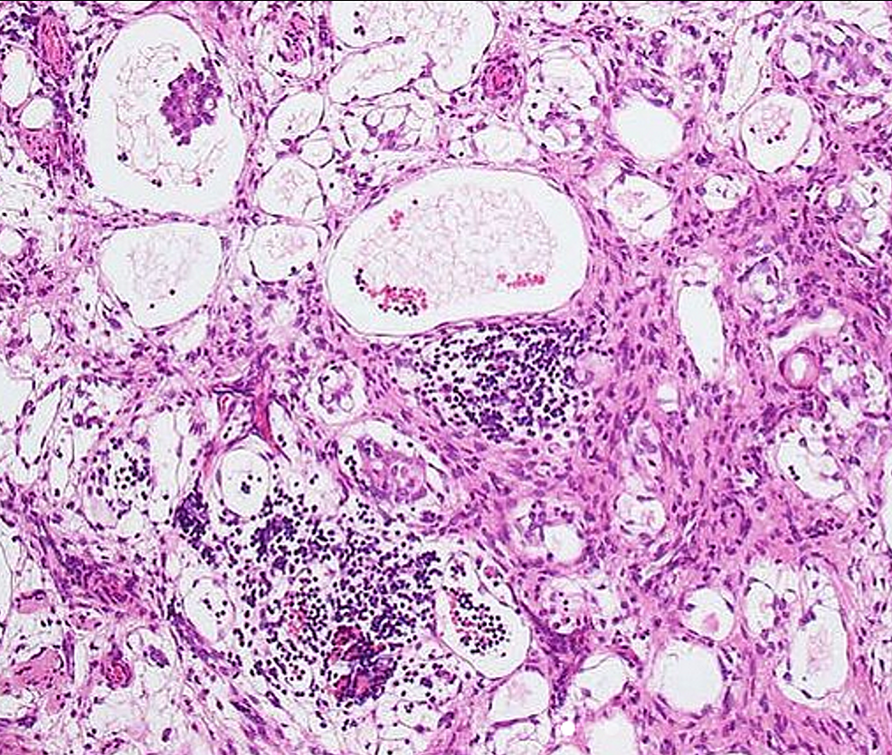 Histopathological-image-shows-cystic-lesions-with-the-presence-of-lymphoid-cells-aggregates-peripherally.