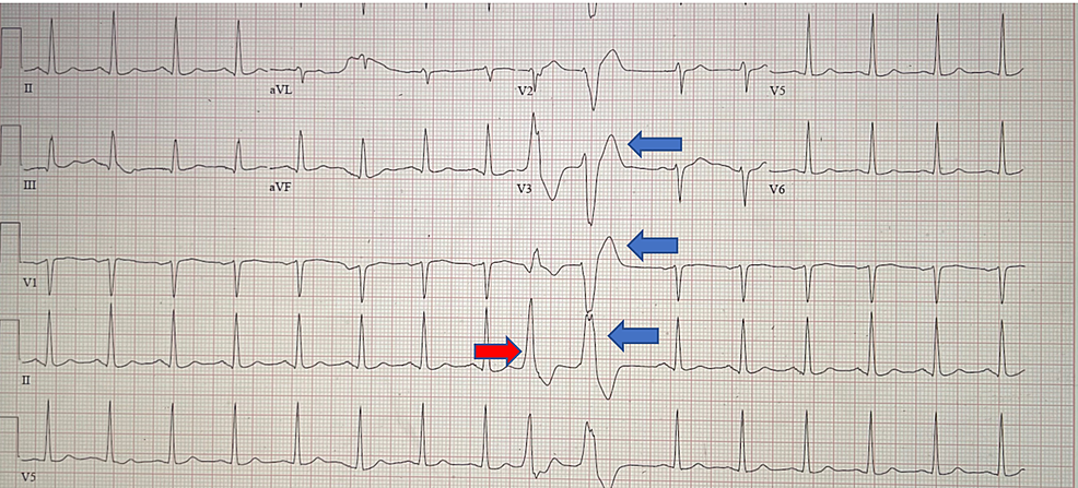 Electrocardiogram-showing-normal-sinus-rhythm-with-occasional-premature-ventricular-complexes-(blue-arrows)-and-nonspecific-ST-and-T-wave-abnormality-(red-arrow)