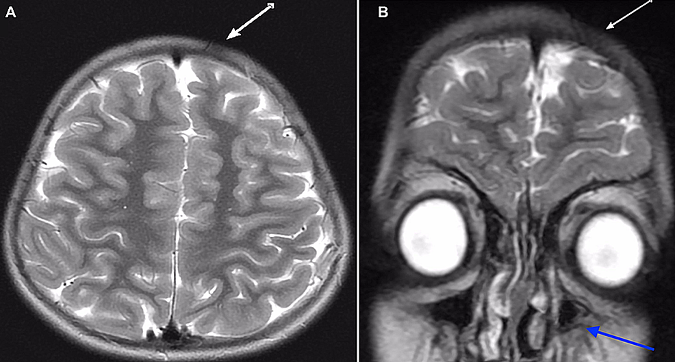 Sagittal-and-coronal-T2-weighted-magnetic-resonance-images-demonstrate-(A)-a-focal-area-of-scalp-thinning-and-subtle-atrophy-of-the-subcutaneous-fat-within-the-left-frontal-region-without-associated-flattening-or-thinning-of-the-underlying-frontal-bones-and-(B)-no-associated-white-matter-abnormality.-The-left-maxillary-sinus-is-partially-hypoplastic-(blue-arrow).