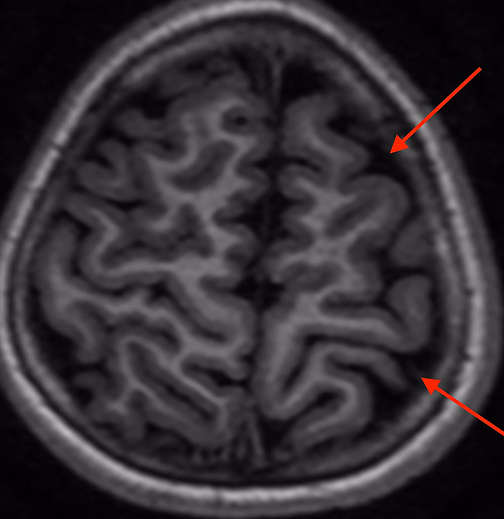 Axial-T1-weighted-magnetic-resonance-image-showing-subtle-atrophy-of-the-left-cerebral-hemisphere-(red-arrow).-There-is-no-cortical-loss-or-abnormal-gyral-formation.