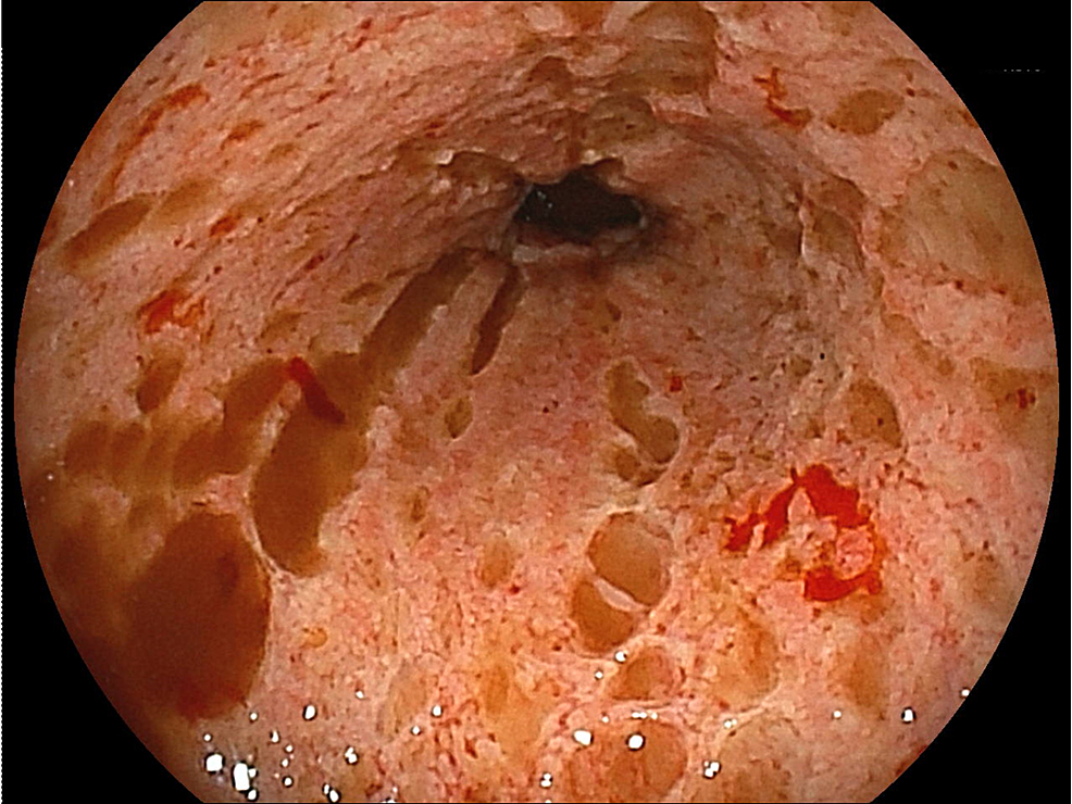 Upper-gastrointestinal-endoscopy-reveals-multiple-round-ulcers-and-erosions-in-the-esophagus.