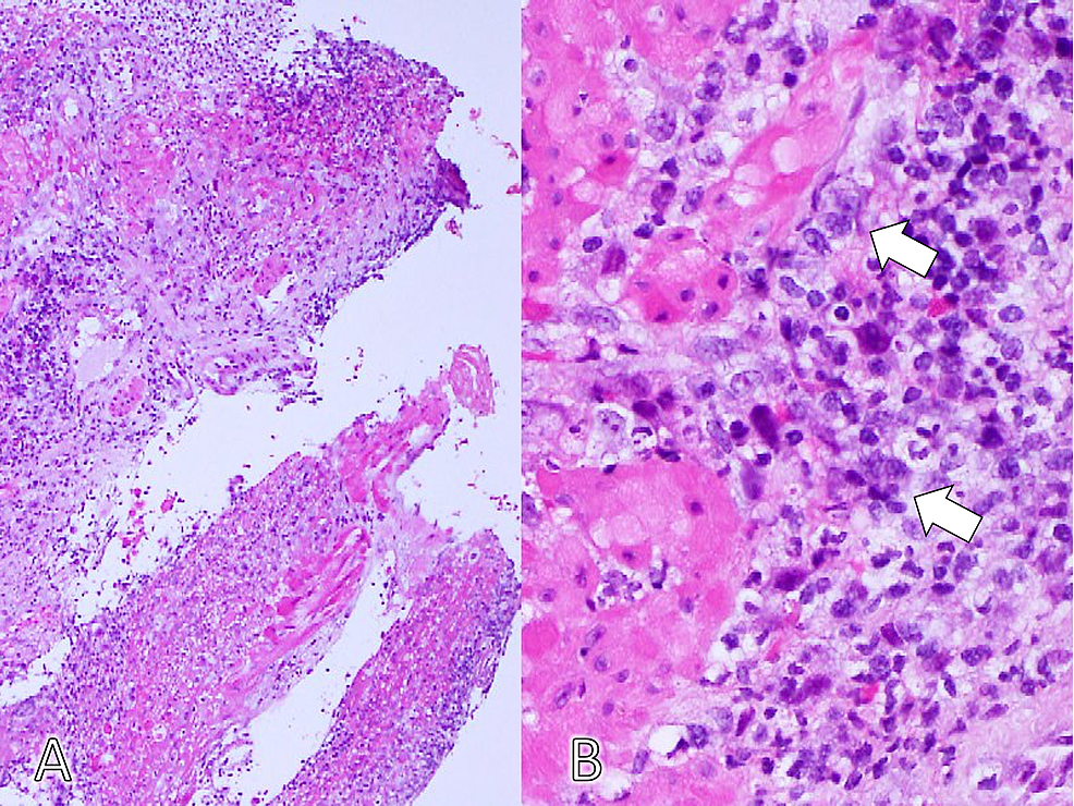 The-histopathological-finding-of-the-edge-of-the-ulcer-shows-giant-cells-with-ground-glass-nuclei-and-margination-of-the-chromatin,-indicating-herpes-virus-infection-(hematoxylin-and-eosin-stain,-A:-×40,-B:-×400).