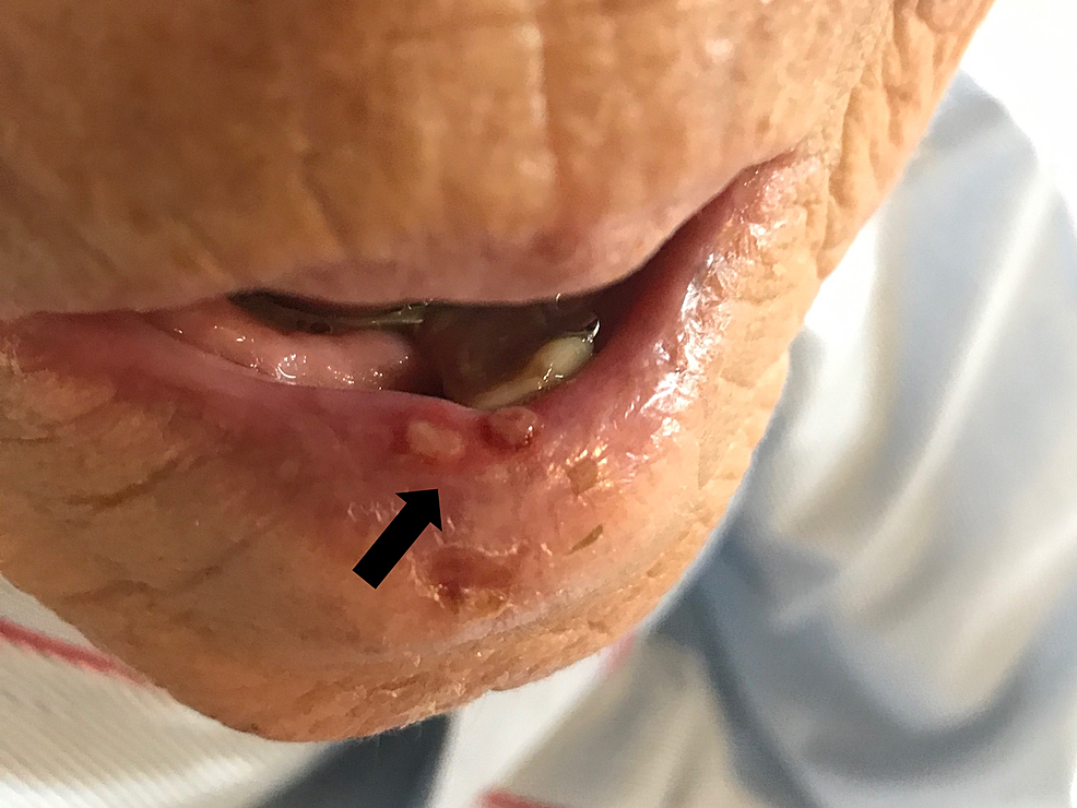 Blisters-seen-on-the-patient’s-lower-lip.