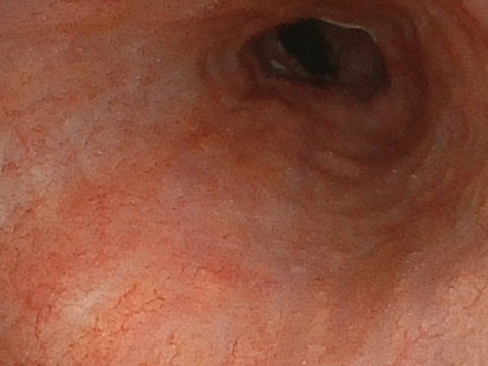 Follow-up-of-the-upper-gastrointestinal-endoscopy-shows-the-healed-mucosa-of-the-esophagus.
