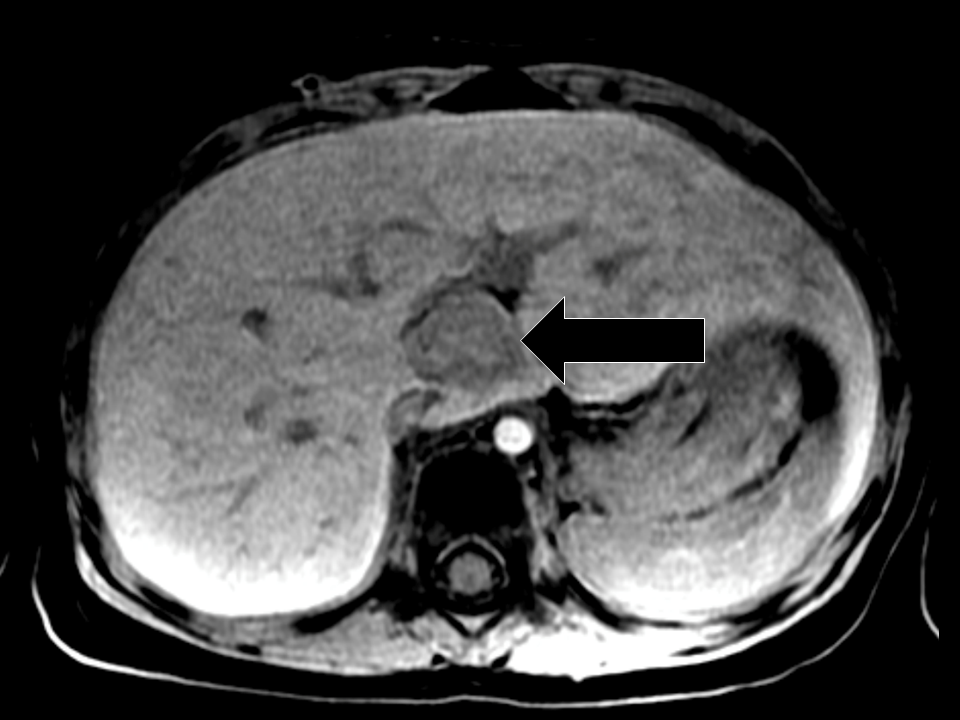 Cureus Surveillance Screening in LiFraumeni Syndrome Raising