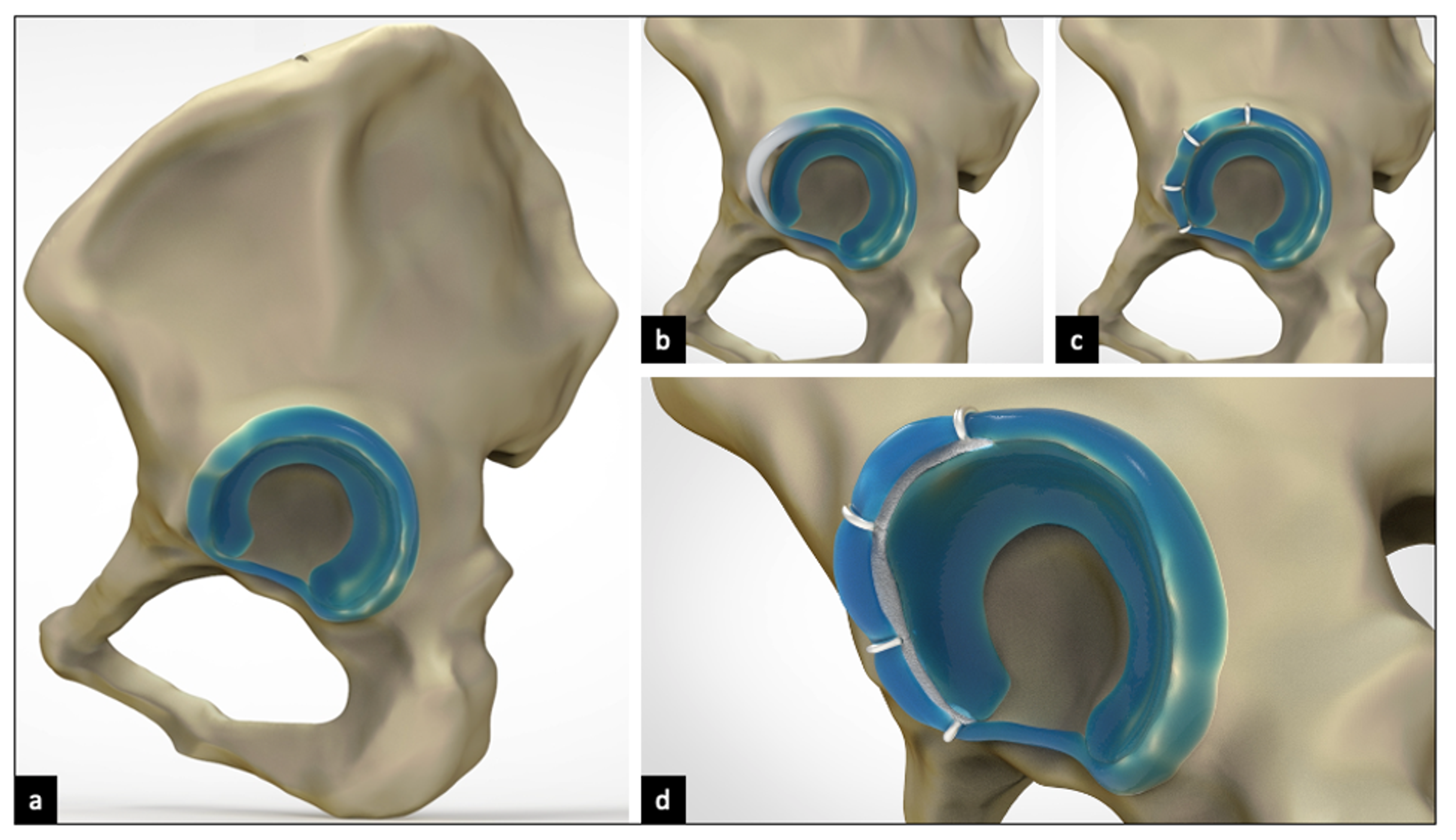 Cureus Introducing a Novel Combined Acetabuloplasty and Chondroplasty