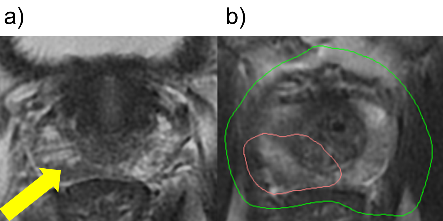 Cureus Stereotactic Radiosurgery for Prostate Cancer Following