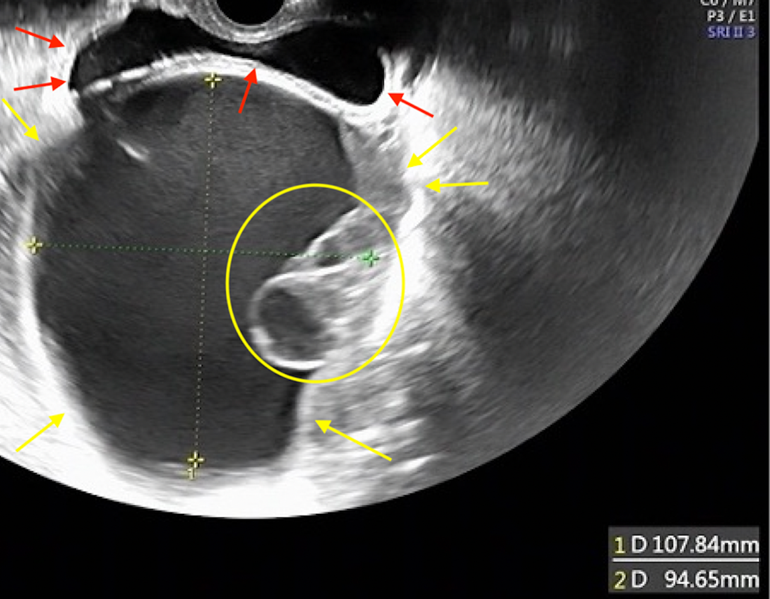 ovarian cancer tumor ultrasound