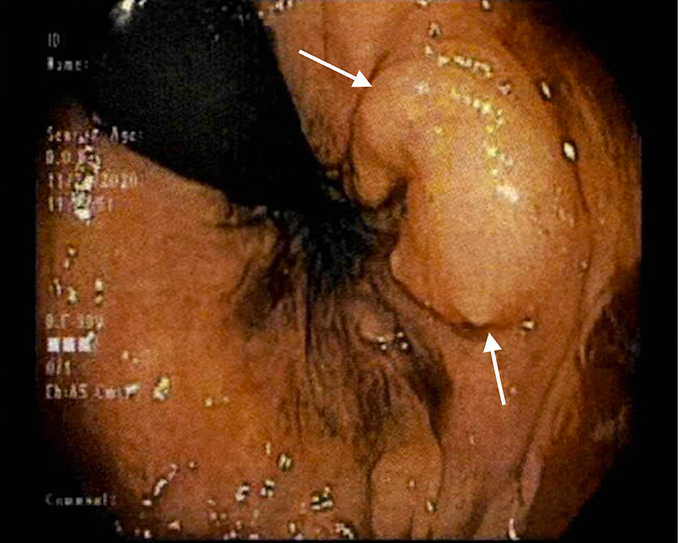 A-1cm-submucosal-lesion-noted-on-the-left-side-of-the-rectum.-