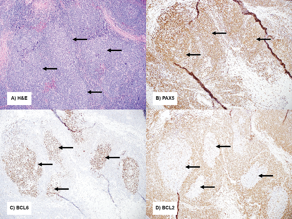 (A)-H&E-stained-sections-of-the-resection-specimen--showed-expanded-secondary-follicles-(see-arrows);-(B)-PAX5-showed-B-cell-follicles-(see-arrows);-(C)-BCL6-highlighted-germinal-centers-(see-arrows);-(D)-BCL2-was-negative-in-germinal-center-B-cells-(see-arrows).