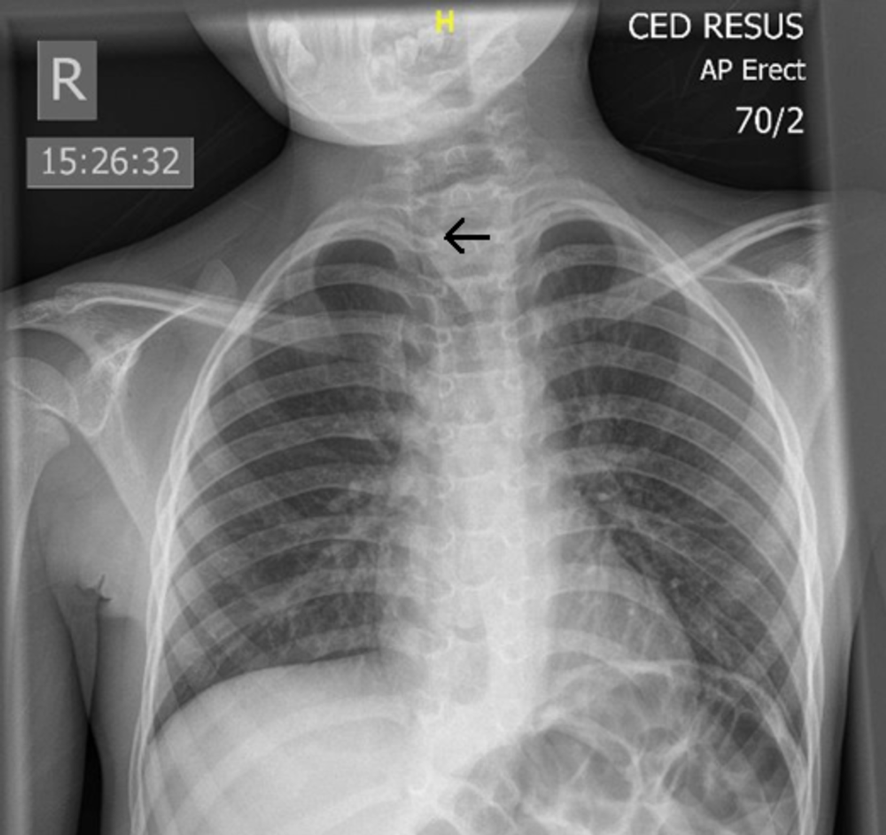 Cureus Acute Paediatric Tracheal Deviation and Neck Lump Secondary to