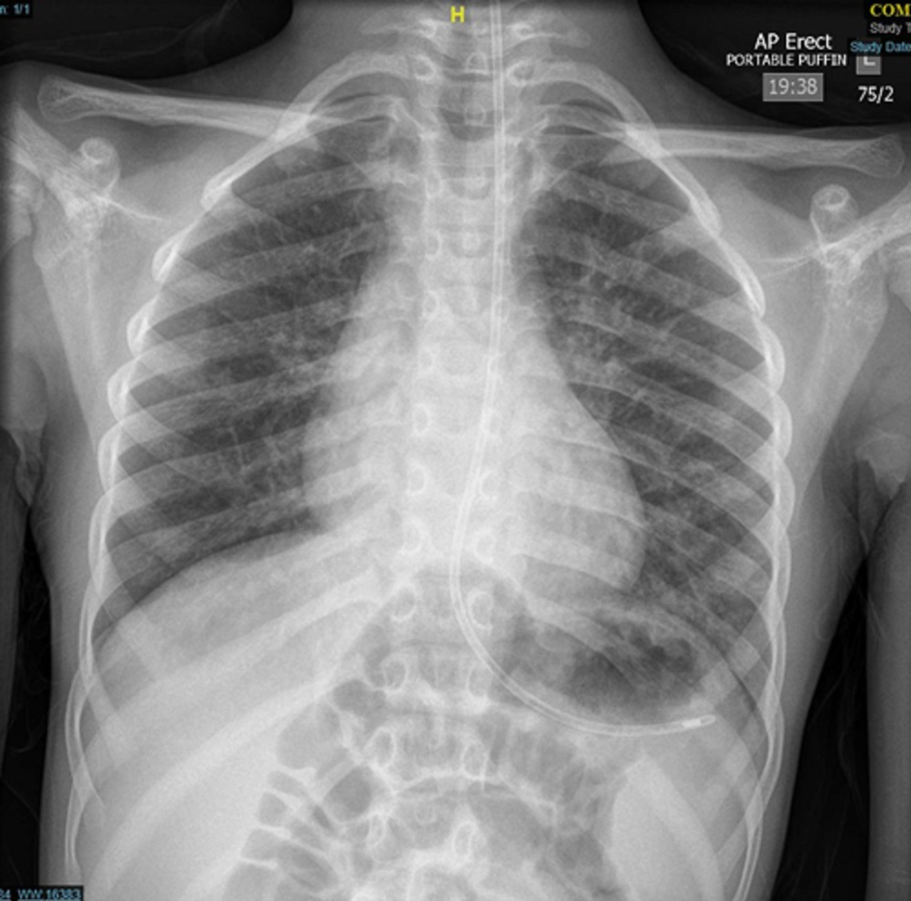 Cureus | Acute Paediatric Tracheal Deviation and Neck Lump Secondary to ...