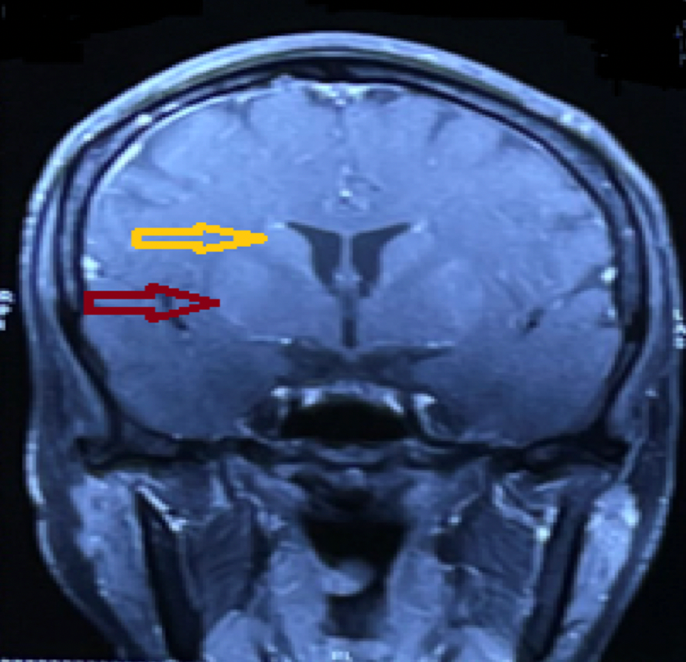 Cureus Seronegative Autoimmune Basal Ganglia Encephalitis Presenting