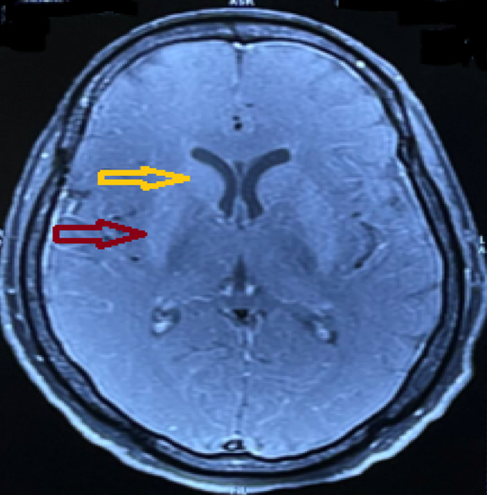 Cureus Seronegative Autoimmune Basal Ganglia Encephalitis Presenting
