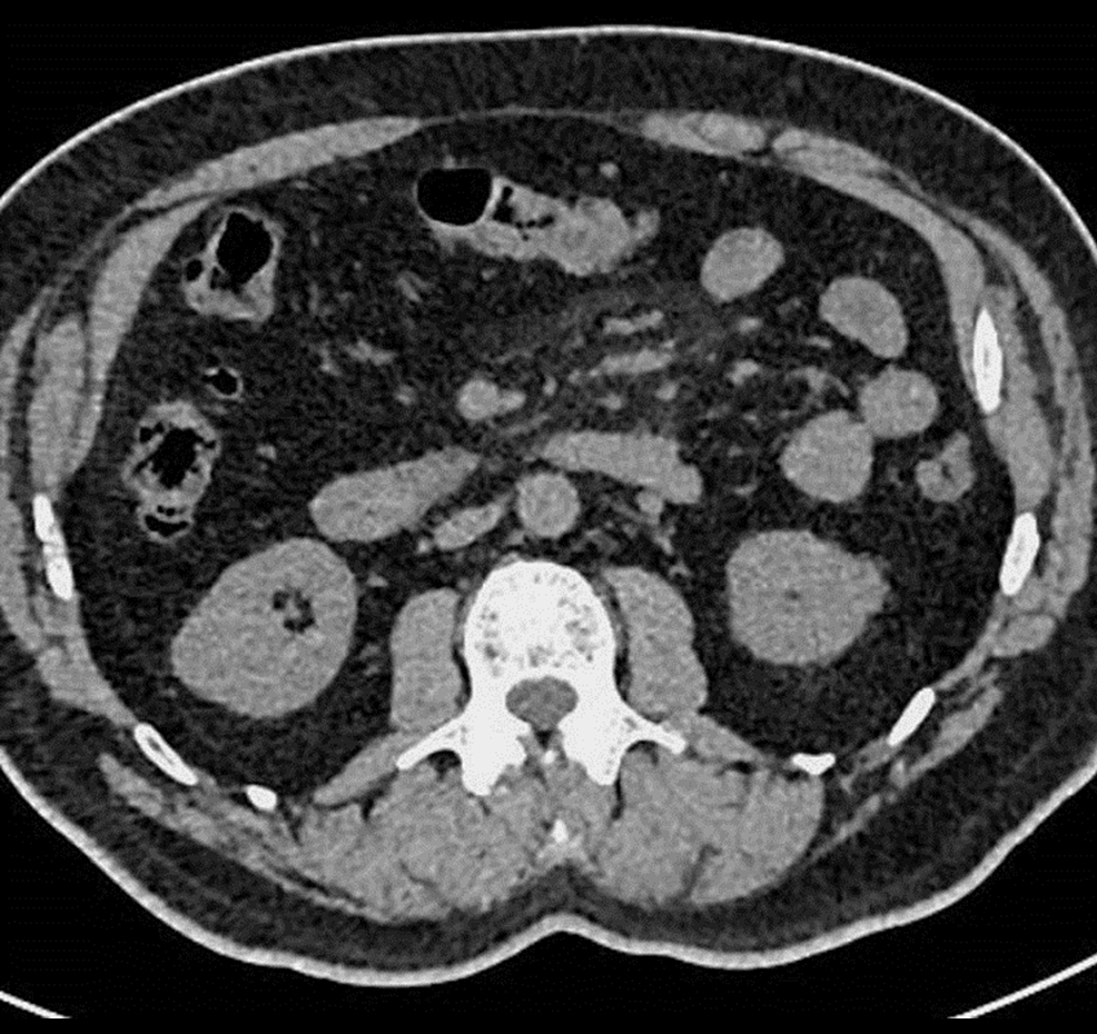 cureus-mesenteric-panniculitis-and-covid-19-a-rare-association