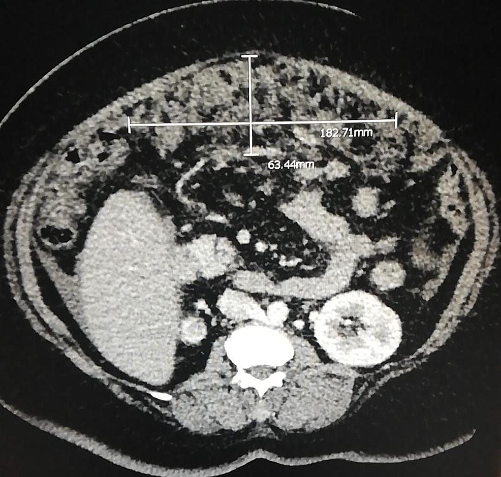 PPT - Classical and hidden faces of the greater omentum in daily abdominal  CT scan PowerPoint Presentation - ID:402696