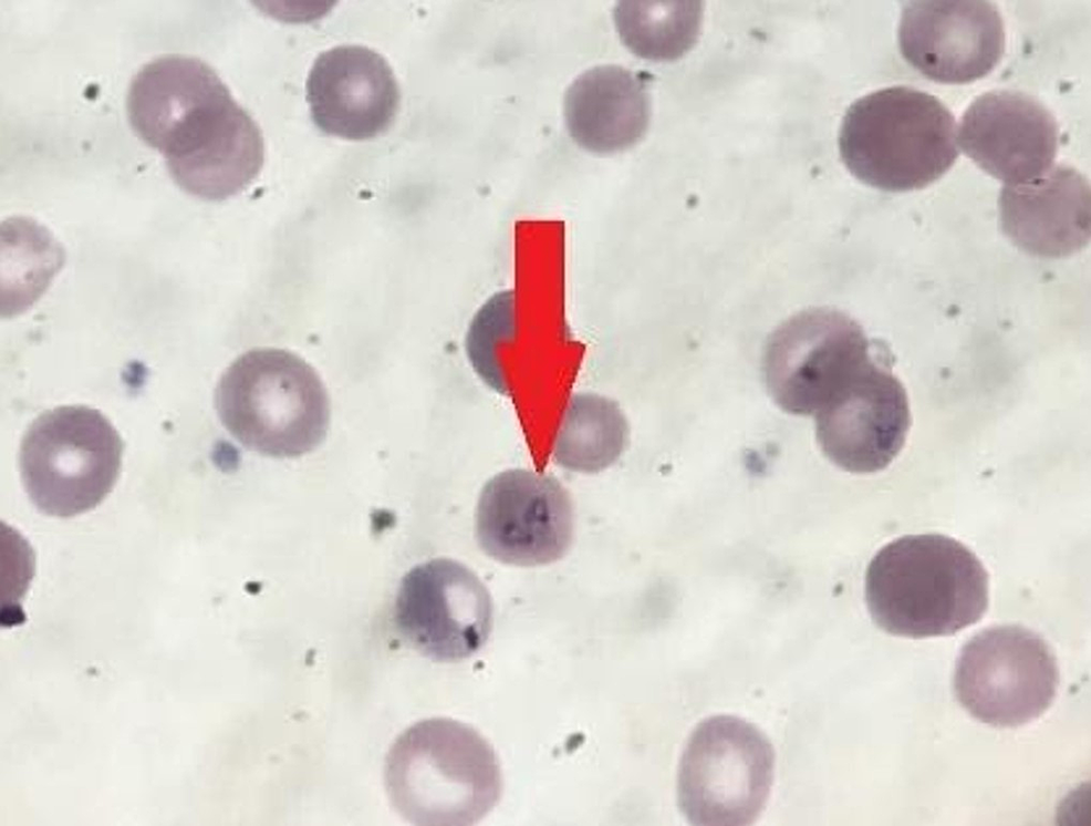 Cureus A Five Week Old Twin With Profound Anemia A Case Report Of Asymmetric Congenital