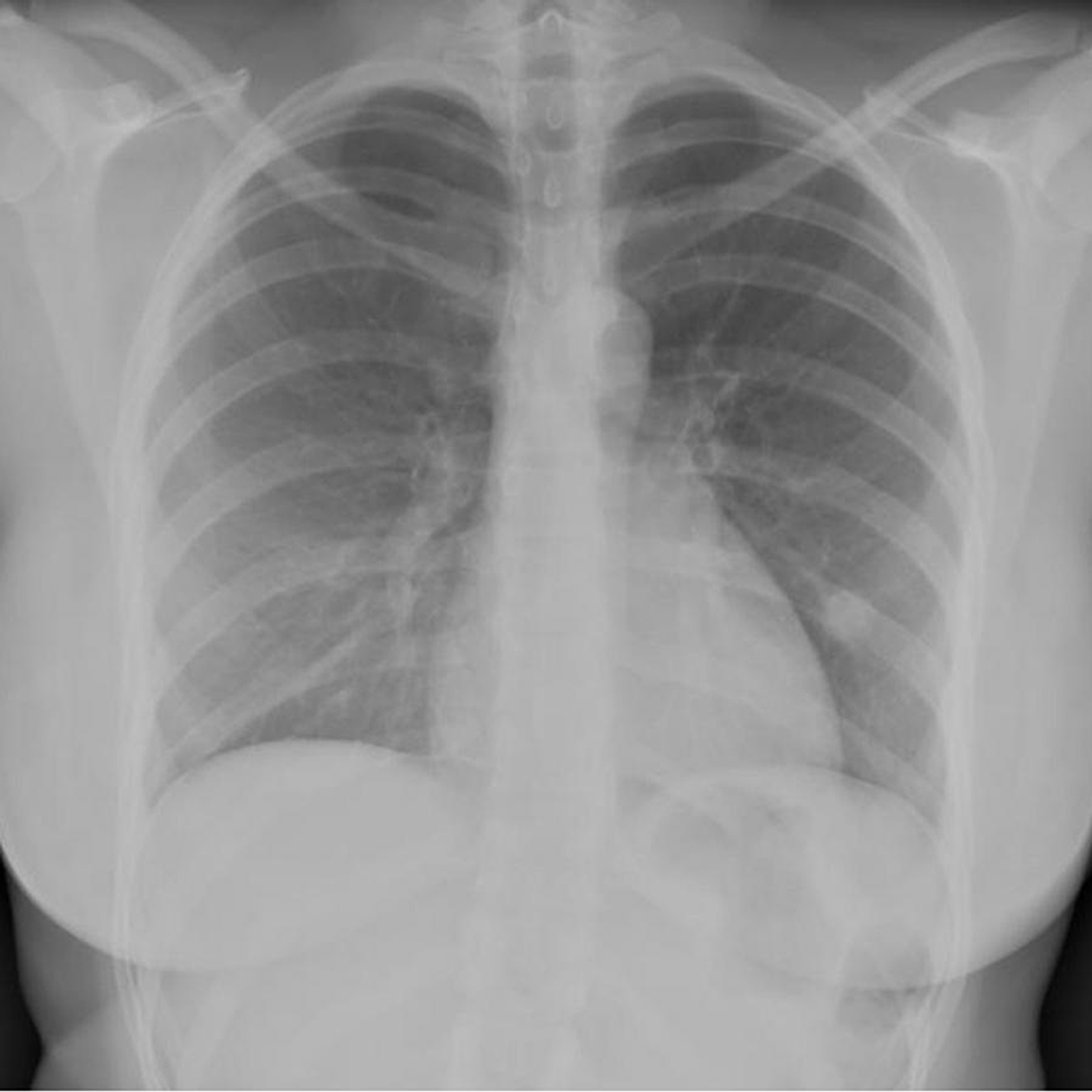 Cureus | Pulmonary Sclerosing Pneumocytoma: An Essential Differential ...