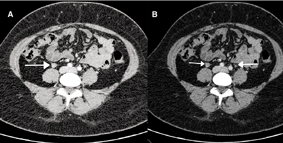 Cureus A Rare Case Of Idiopathic Gonadal Vein Thrombosis