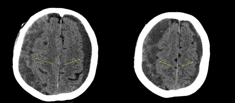 Cureus Unusual Etiology for a Chronic Subdural Hematoma Whole